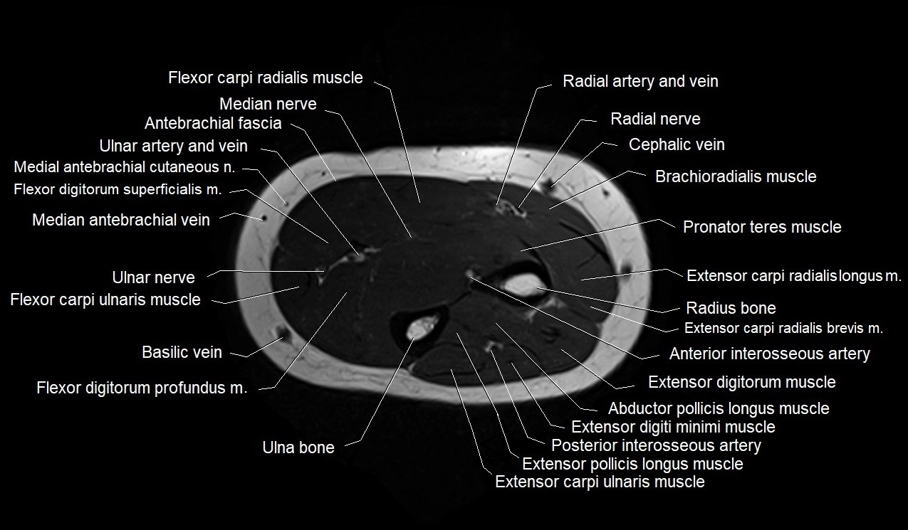 MRI 3T forearm axial cross sectional anatomy image 23.webp